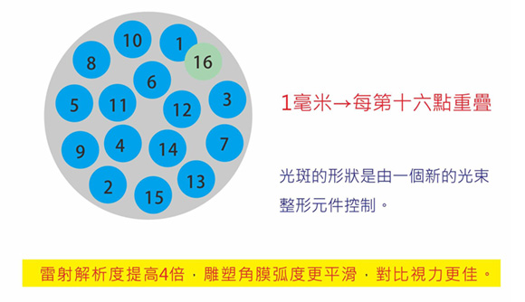 準分子近視雷射,lasik