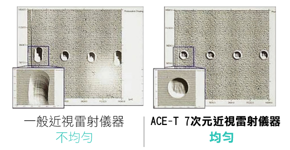 準分子近視雷射,lasik