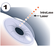 準分子近視雷射,lasik