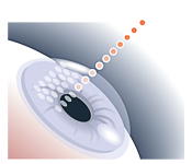 準分子近視雷射,lasik