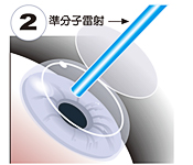 準分子近視雷射,lasik