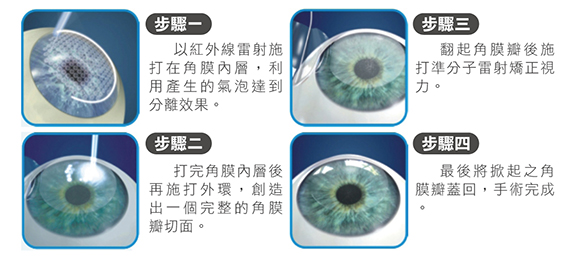 準分子近視雷射,lasik