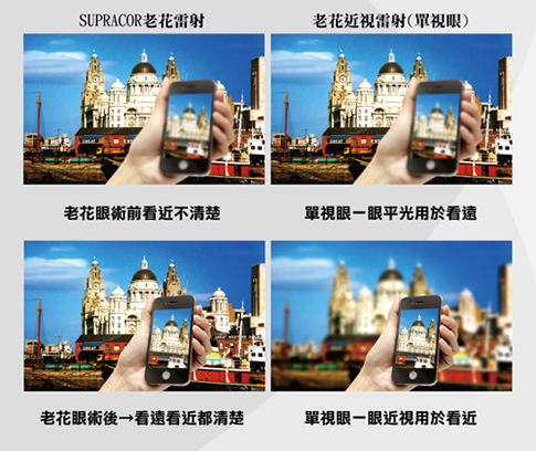 準分子近視雷射,lasik