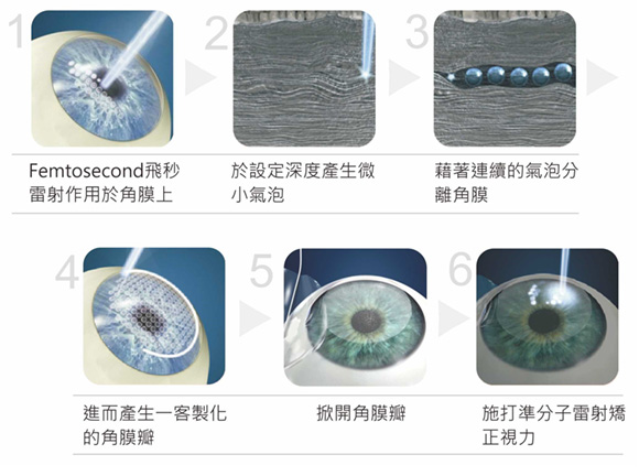 準分子近視雷射,lasik