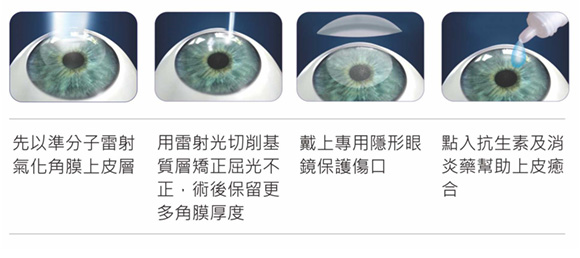 準分子近視雷射,lasik